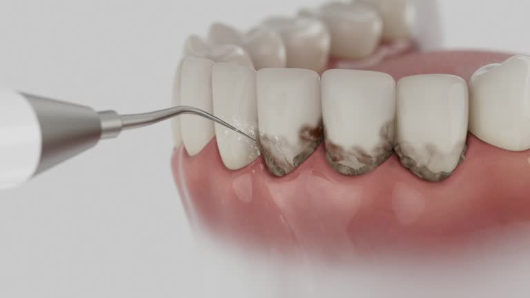 Trusted Wisdom Tooth Removal service in Park City, MT - Dentist Open Now